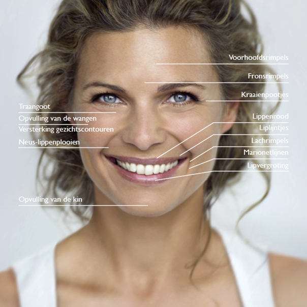 behandelgebieden-esthetiek, restylane