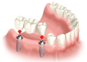 Brug op implantaten door implantoloog Jos Deurloo