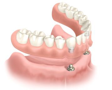 Lang binden Eindeloos Klikgebit op implantaten - CT De kiezel