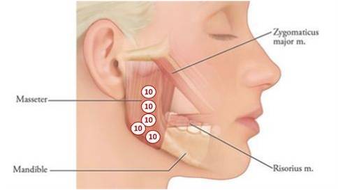 Bruxisme behandelen met botox